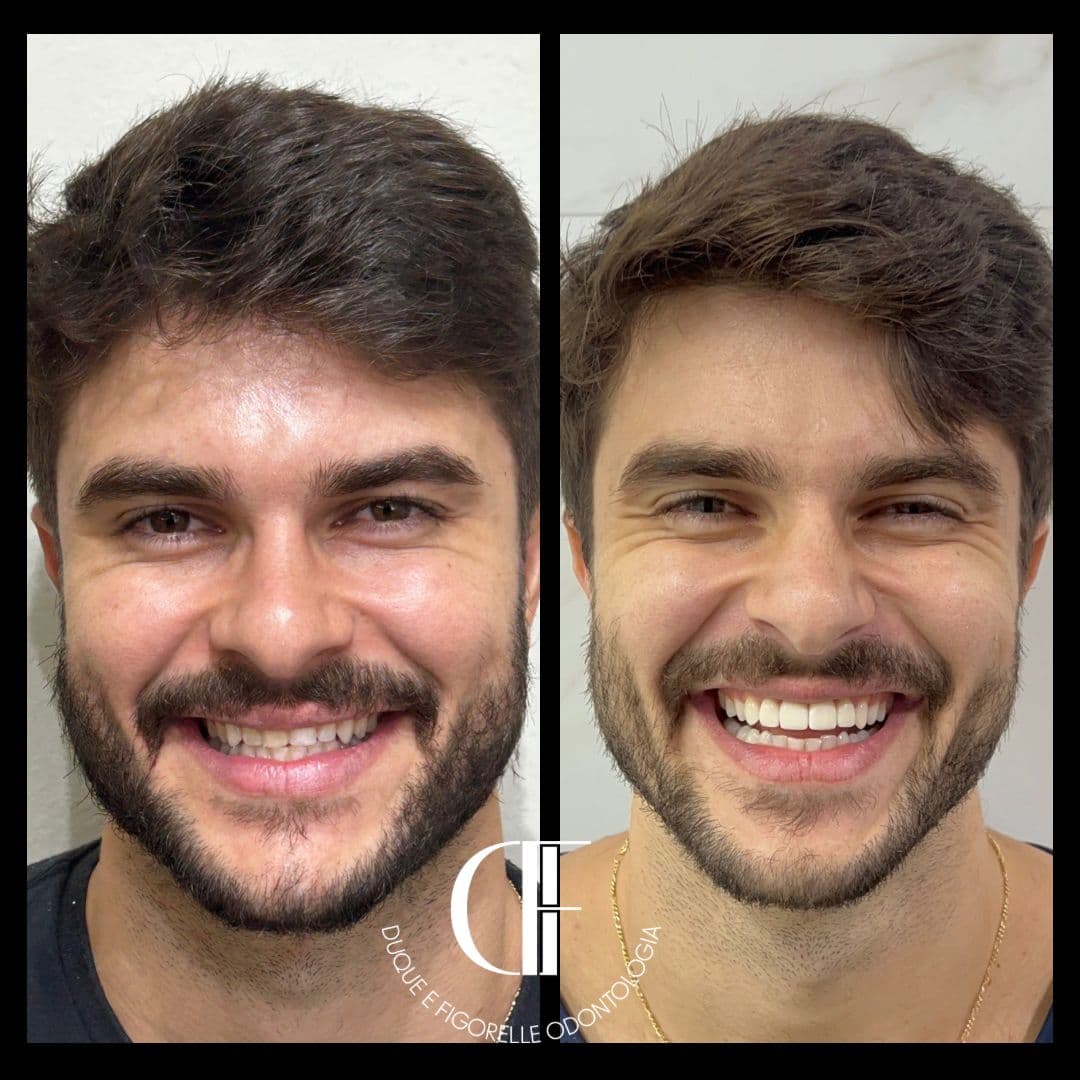Resultado odontológico com comparação de sorriso antes e depois