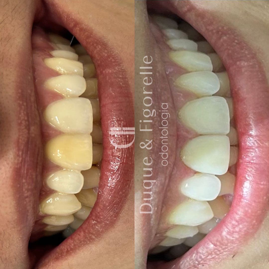 Clareamento com comparação visual antes e depois